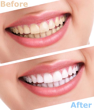 before and after teeth whitening at Precious Smiles Family Dentistry in Tampa, FL